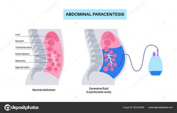 abdominocentesis