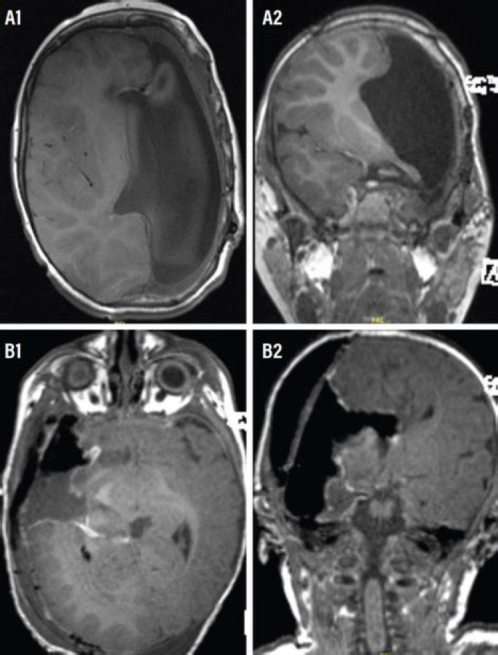 Are Hemispherectomies still done?
