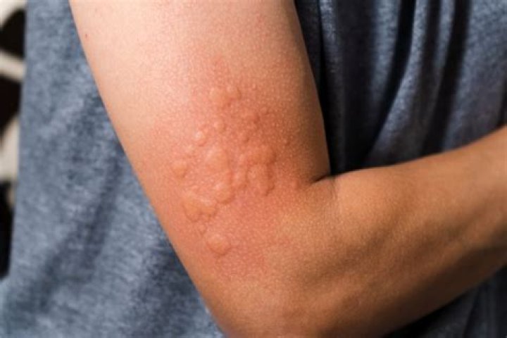 Are people allergic to leather