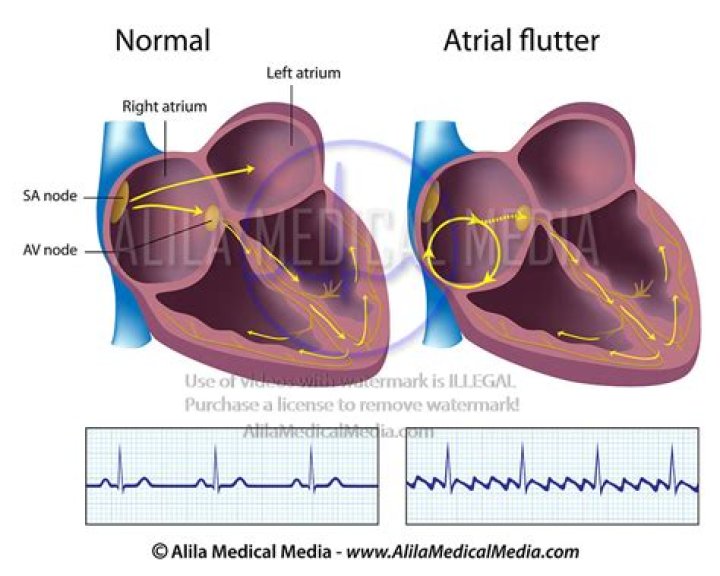 atrial kick definition