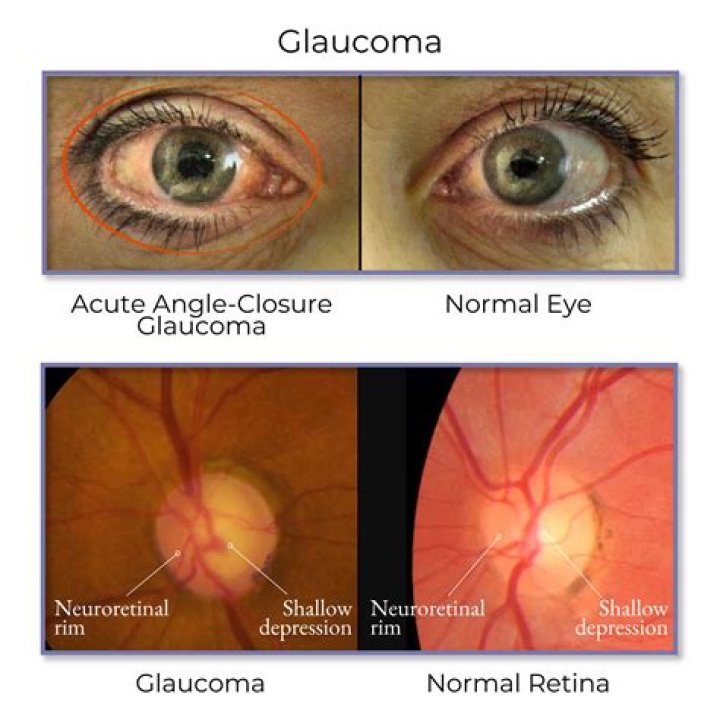 benadryl and glaucoma
