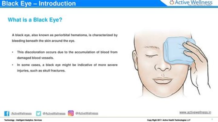 black eye medical term