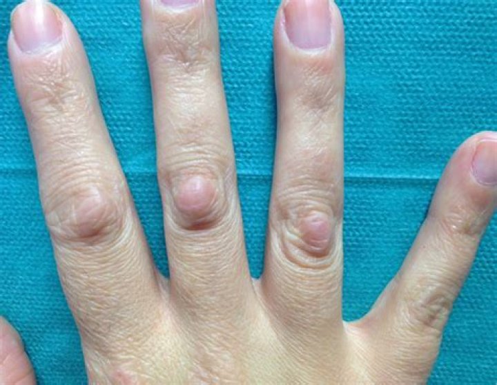 bumps on knuckles