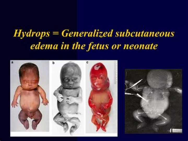 Can a baby survive fetal hydrops