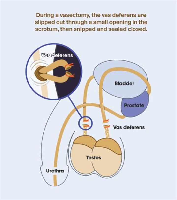 Can a vasectomy be reversed Australia?