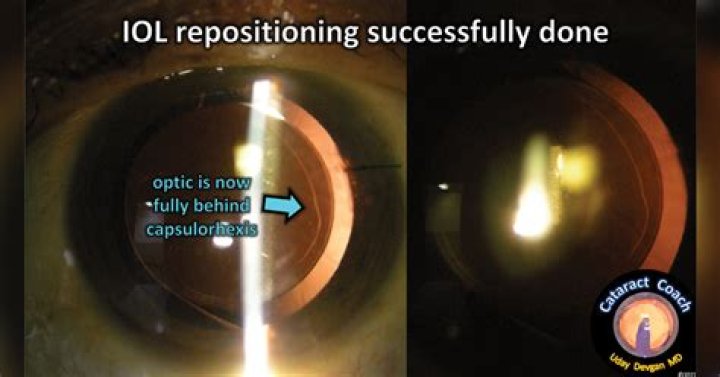 Can an IOL be repositioned