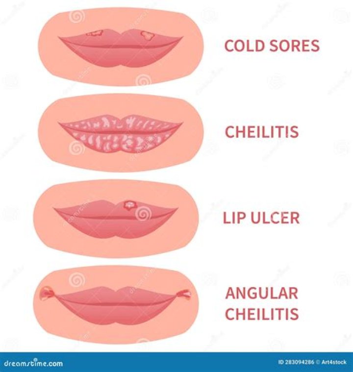 Can angular cheilitis cause swollen lips