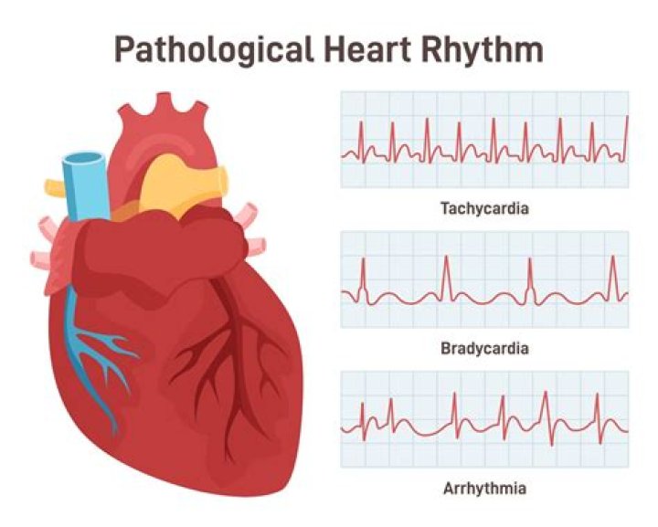 Can arrhythmias cause palpitations