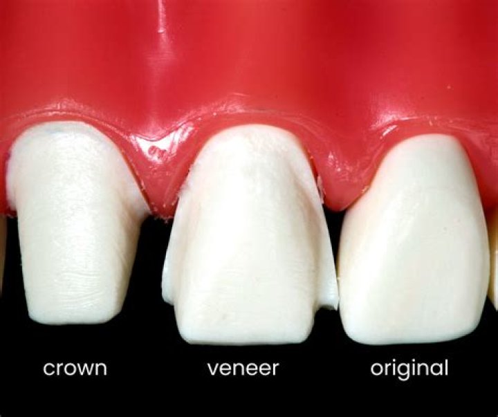 Can I get a veneer on one tooth