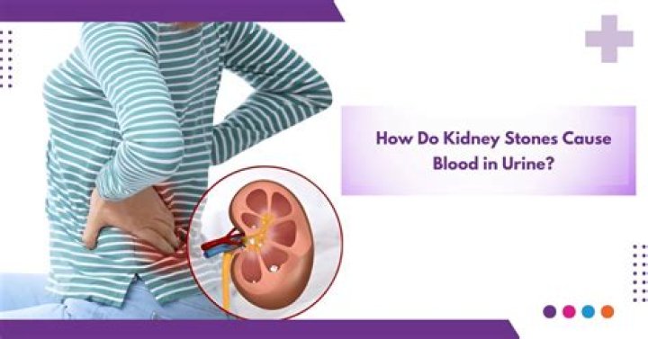 Can kidney stones cause bleeding