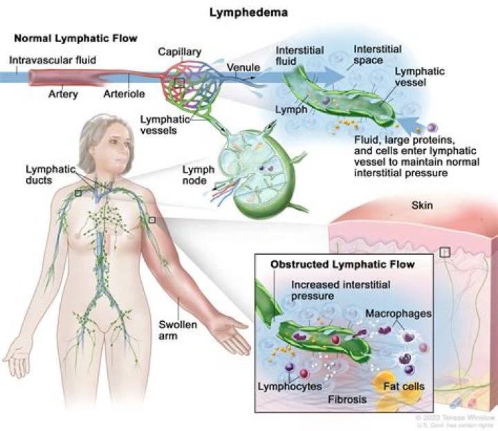Can lymphatic system cause swelling