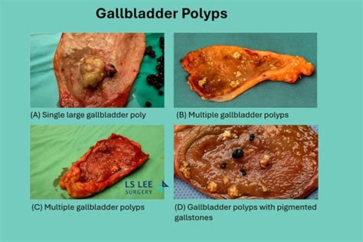 Can polyps in gallbladder cause nausea?