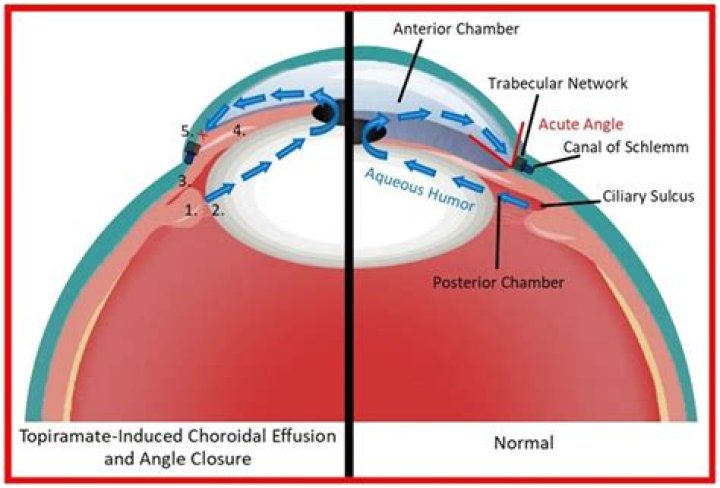 Can topiramate cause myopia?