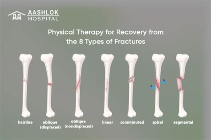 Can you fully recover from a broken femur