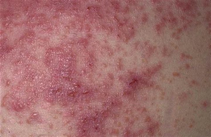 celiac rash