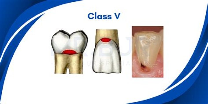 class v cavity