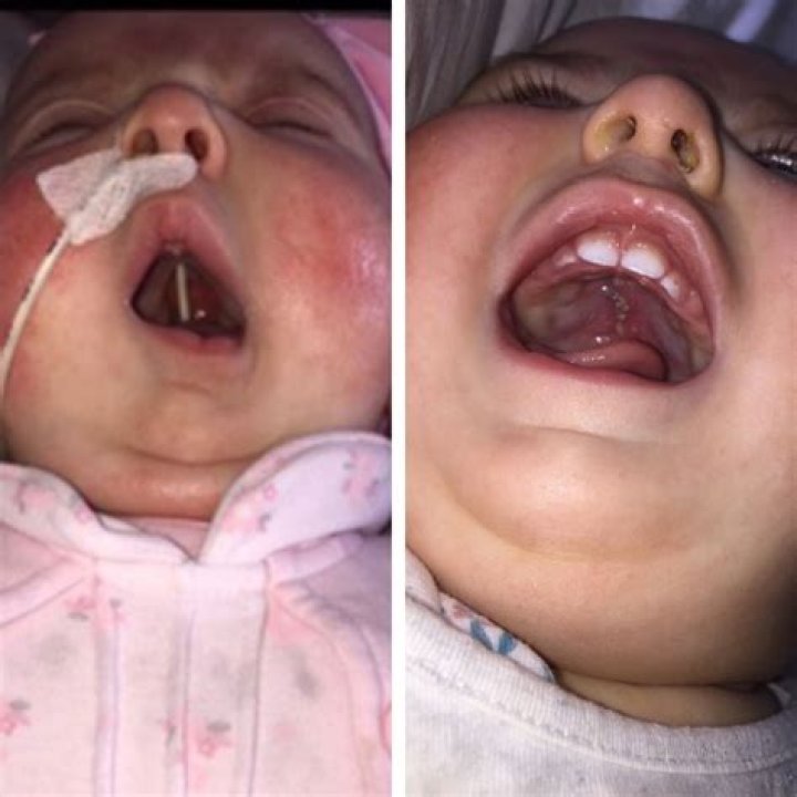 cleft palate pacifier