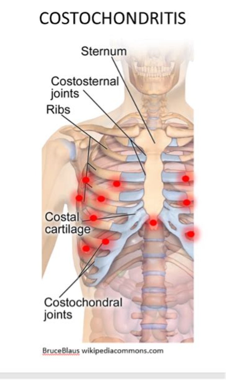 costochondral separation treatment