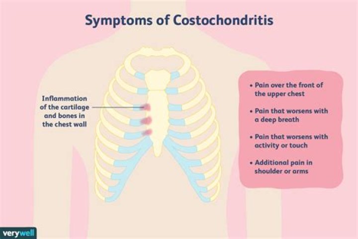 costochondritis shoulder pain