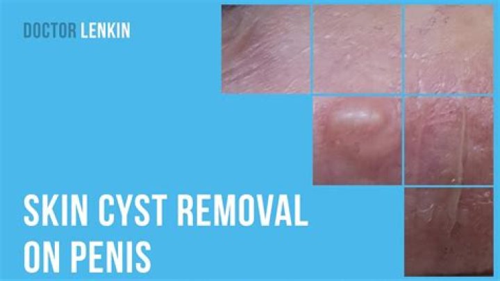 cyst on penis