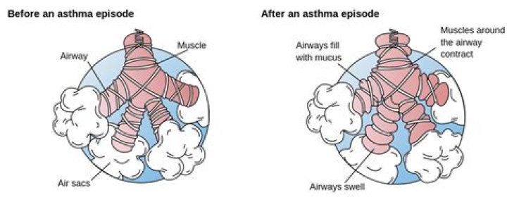 difference between stridor and wheezing