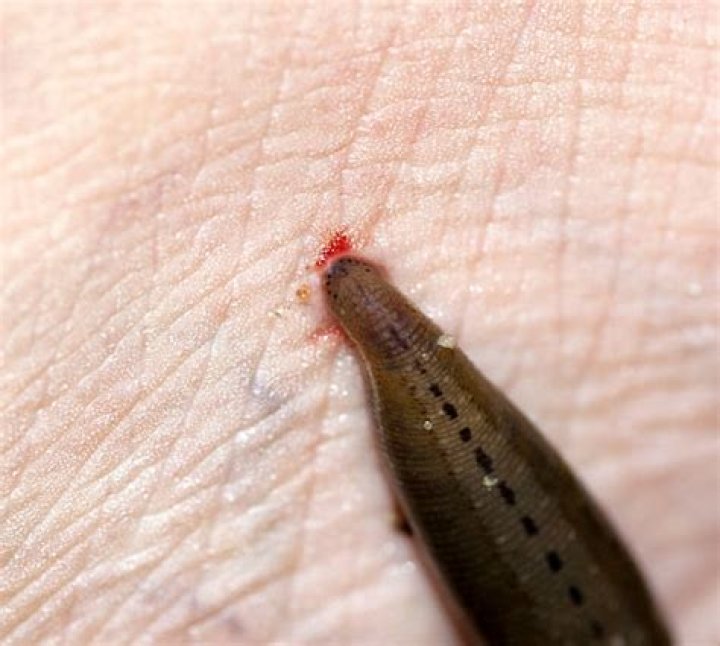 do leech bites hurt
