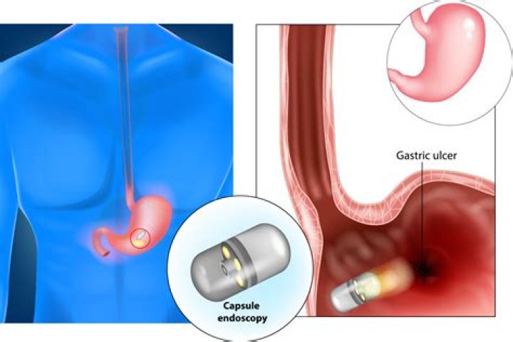 Do peptic ulcers need surgery