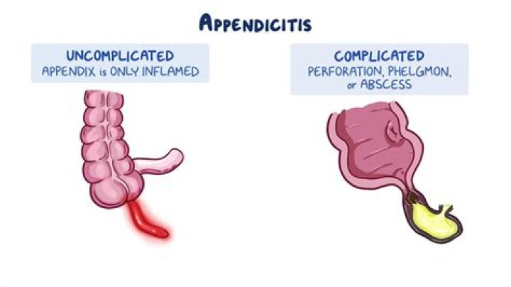Does Appendicitis pain come in waves