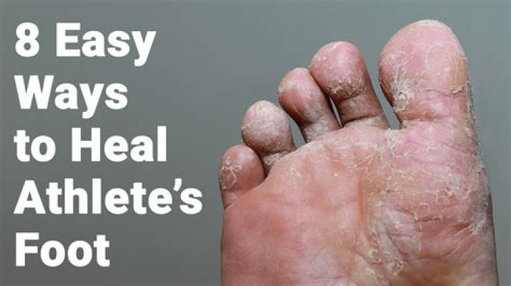 does bleach kill athlete’s foot