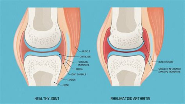 Does knee arthritis go away?