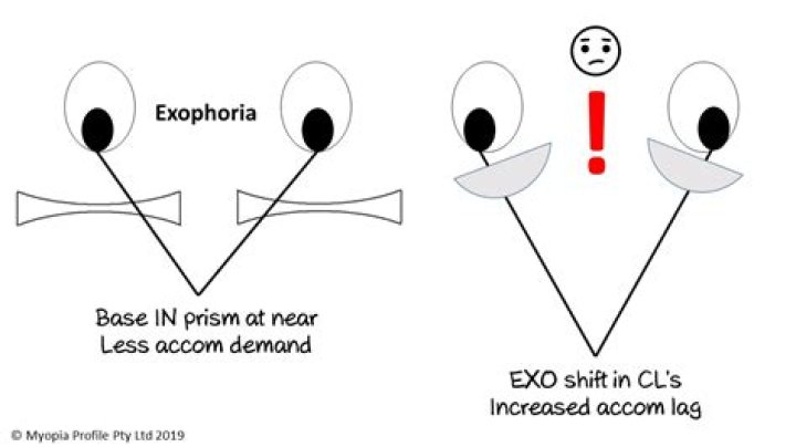 exophoria
