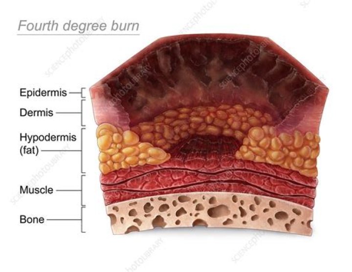 fourth degree burn