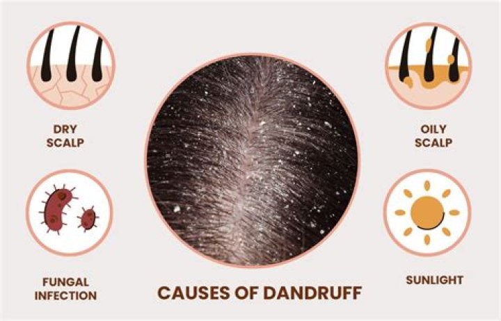 How can I get rid of dandruff without washing my hair?
