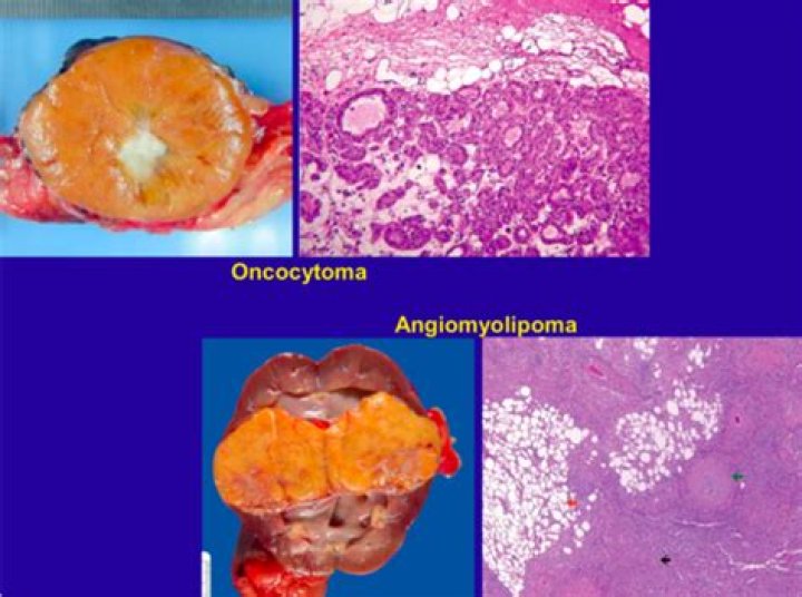 How common are oncocytomas?