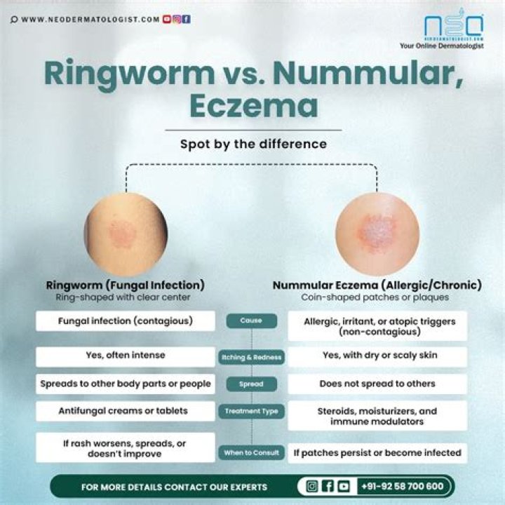 How do you describe nummular eczema