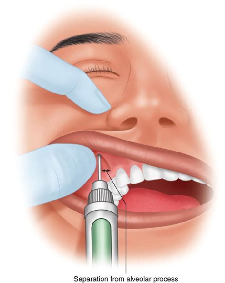 How do you get Pulpal anesthesia?