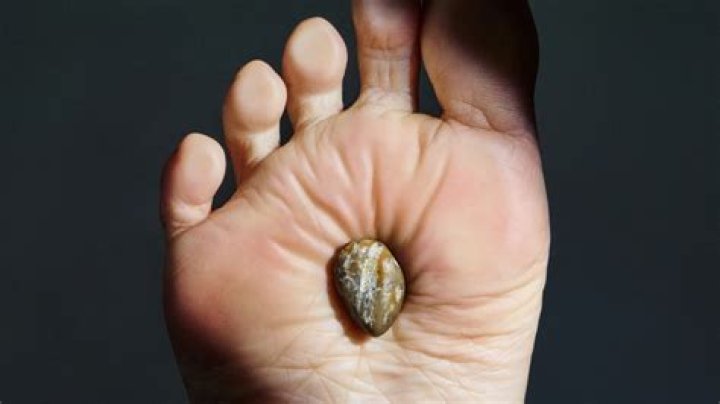 How do you get rid of warts on your neck