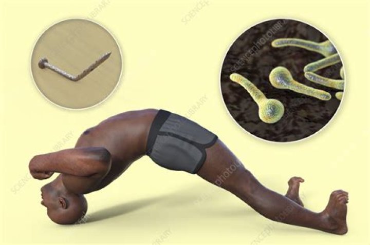 How do you manage Opisthotonus?