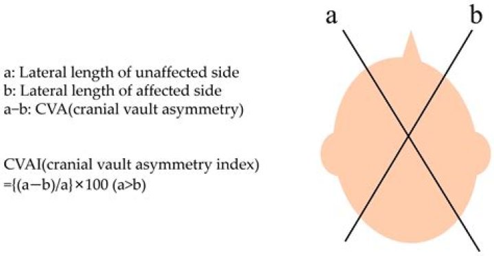 How do you measure cranial vault asymmetry index