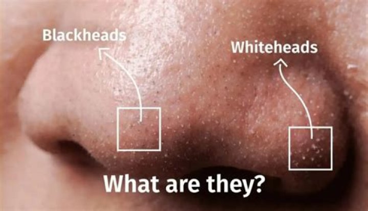 How do you pop white heads naturally?