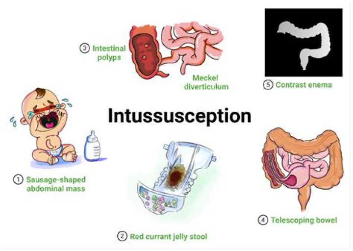 How do you prevent intussusception