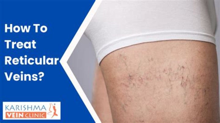 How do you treat reticular veins
