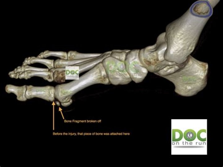 How does an avulsion heal