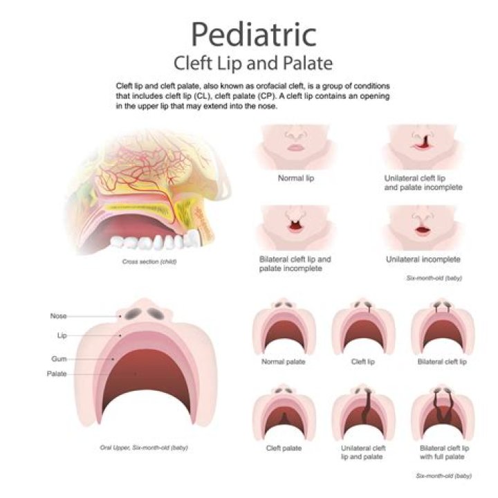 How does cleft palate affect swallowing