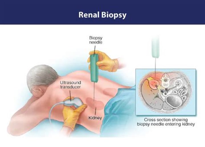 How is a kidney biopsy performed