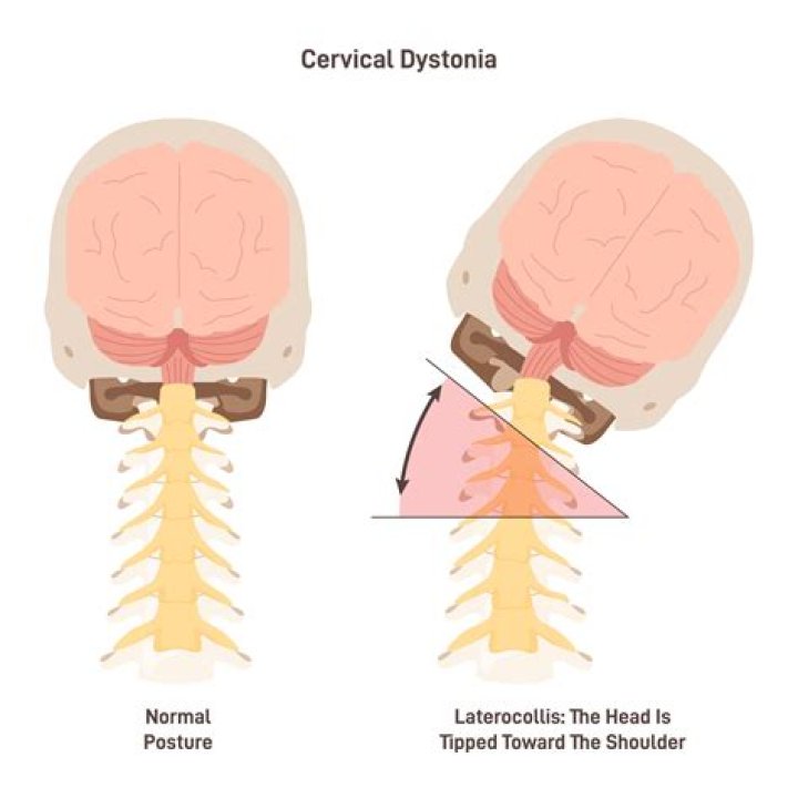 How is spasmodic torticollis diagnosed