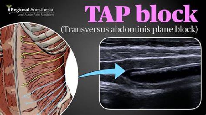 How is TAP block administered?