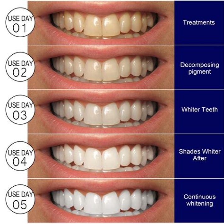 How long do you leave teeth whitening trays in?