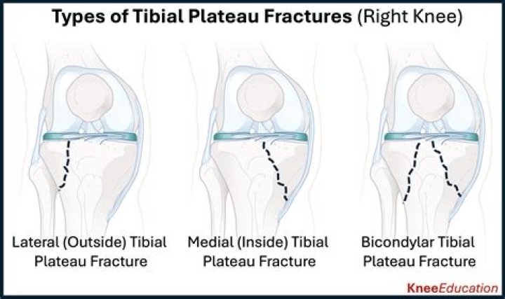 How long does a subchondral fracture take to heal?