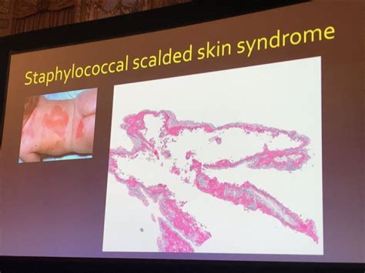 How long does scalded skin syndrome last